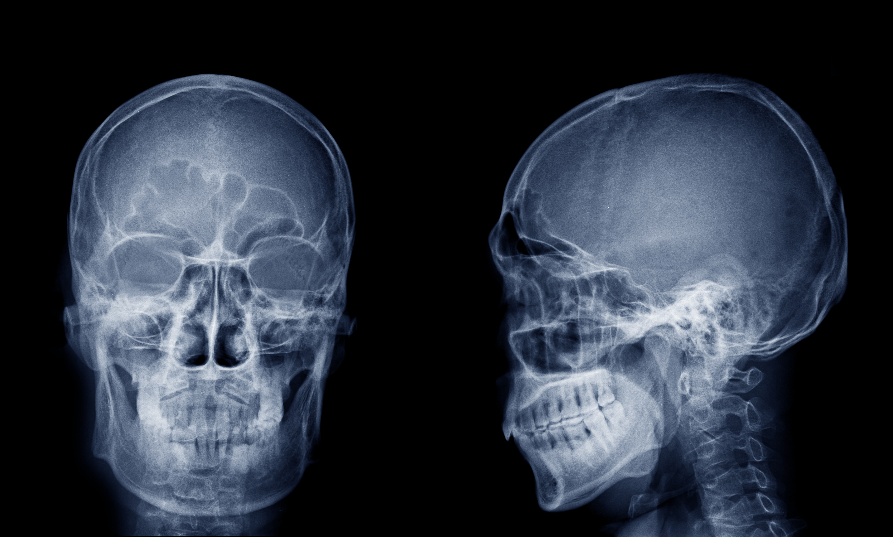 Röntgenaufnahme von Schädel frontal und linksseitig